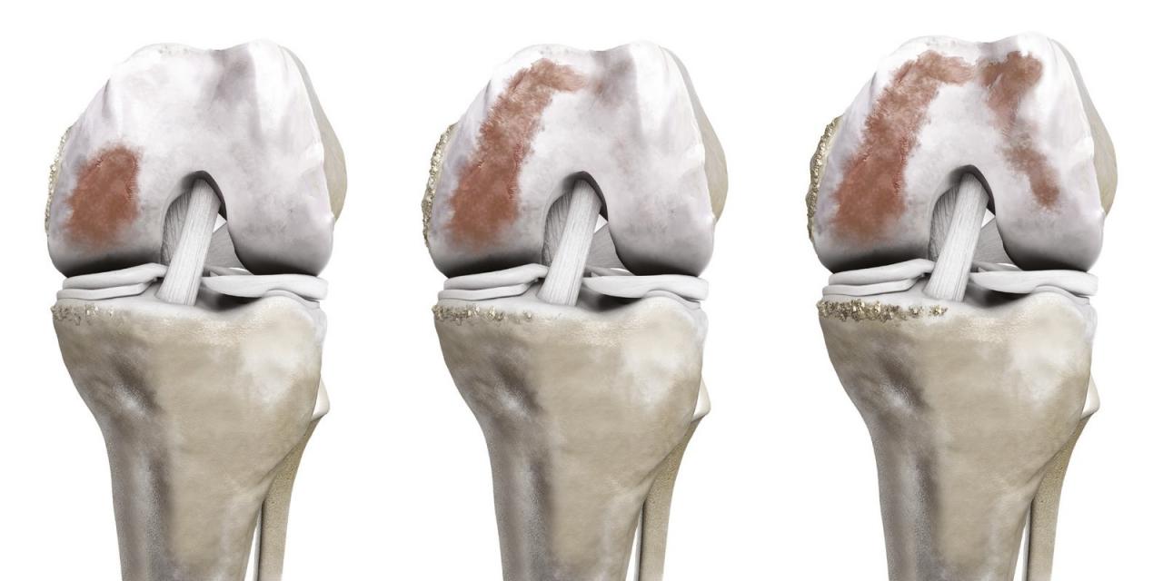 Kniearthrose in 1, 2 oder 3 Kompartimenten